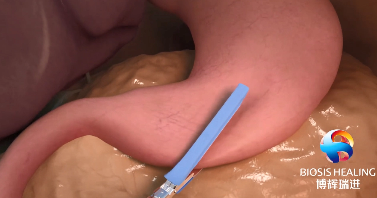 تعزيز خط التيلة (SLR) للحد من التسريبات