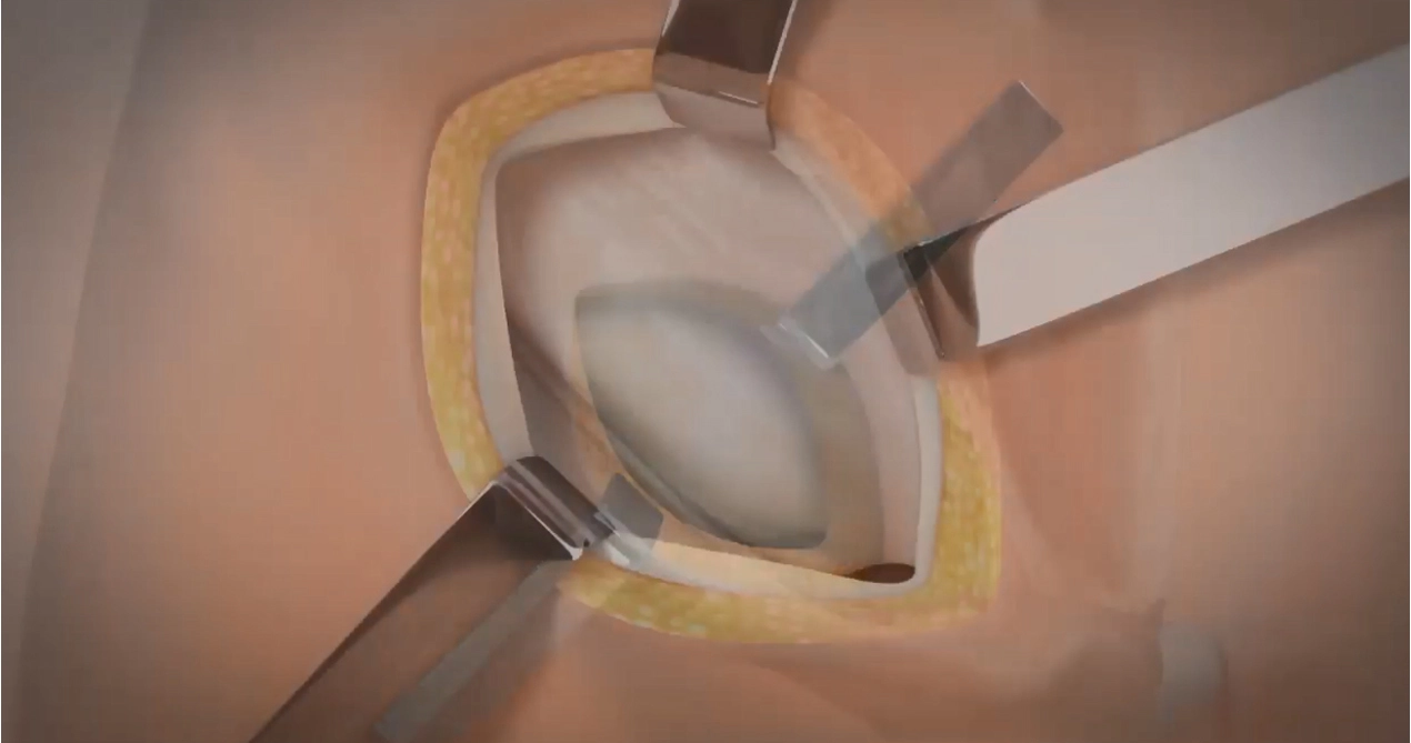 إصلاح فتق ليشتنشتاين مع شبكة SIS قابلة للامتصاص