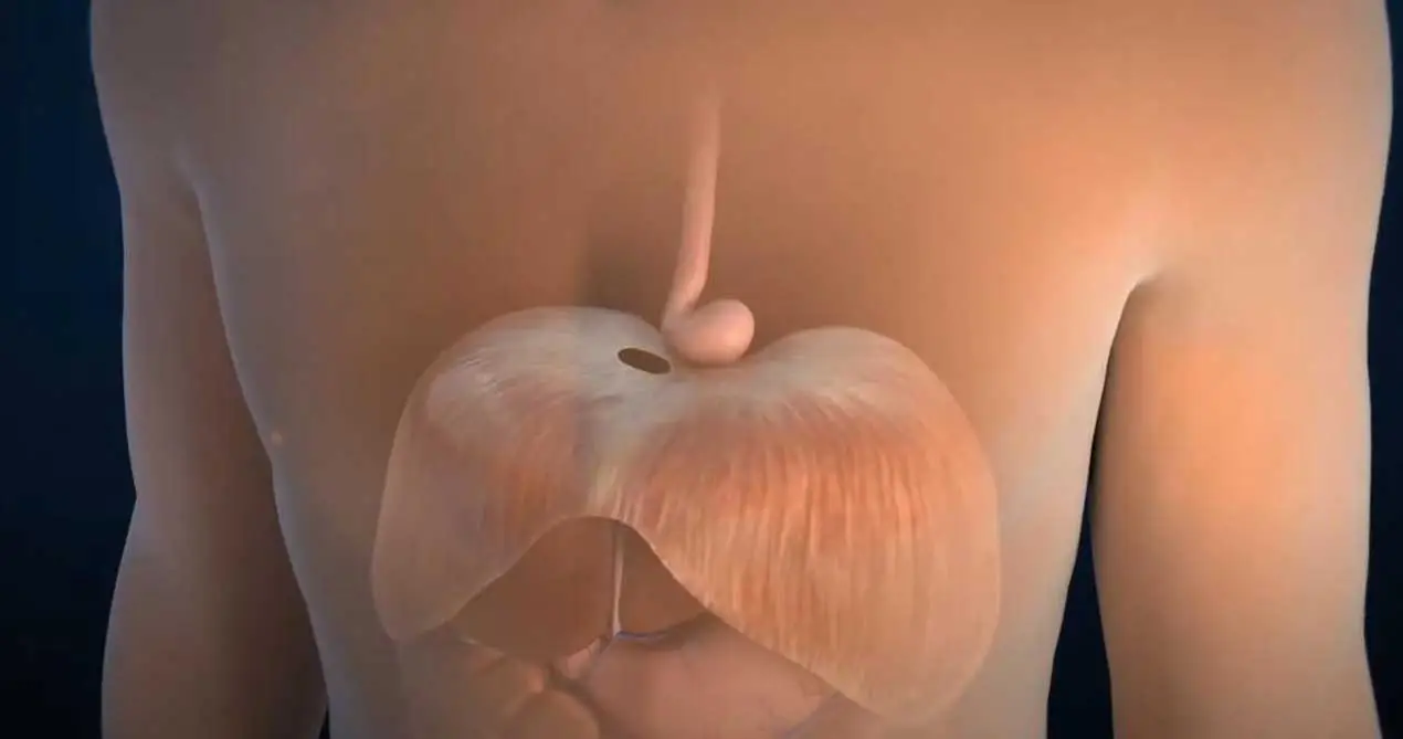 إصلاح الفتق المريئي مع شبكات بيولوجية SIS