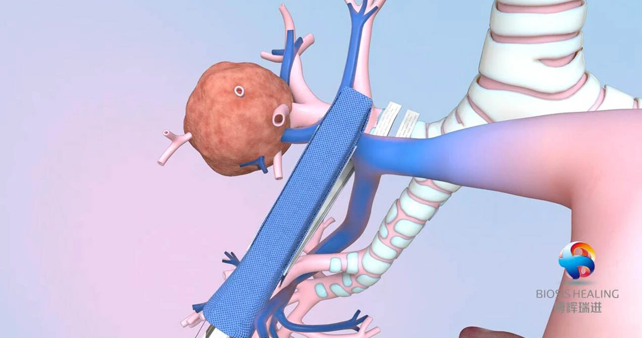 تعزيز خط التيلة لاستاستئصال الفص